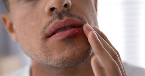 Understanding Herpes Breakout on Black Skin: Symptoms, Treatment, and Prevention Strategies