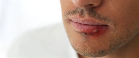 Understanding Herpes Breakout on Black Skin: Symptoms, Treatment, and Prevention Strategies